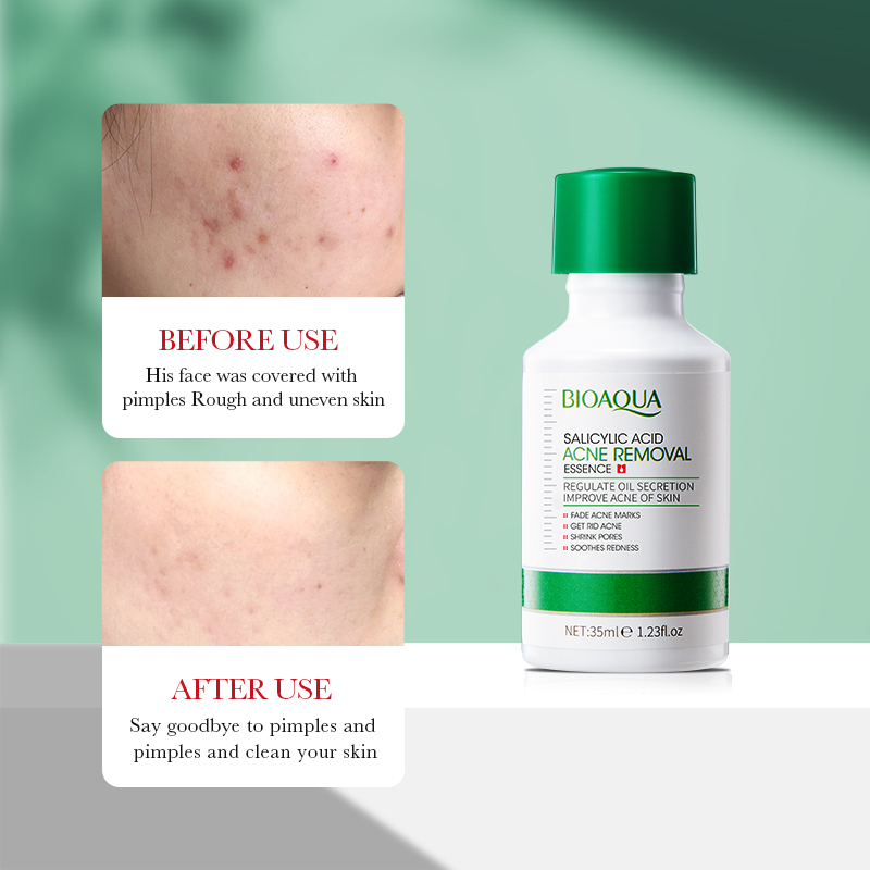35ml BIOAOUA Salicylic Acid An - đánh giá và giá Salicylic Acid Blackhead Remover