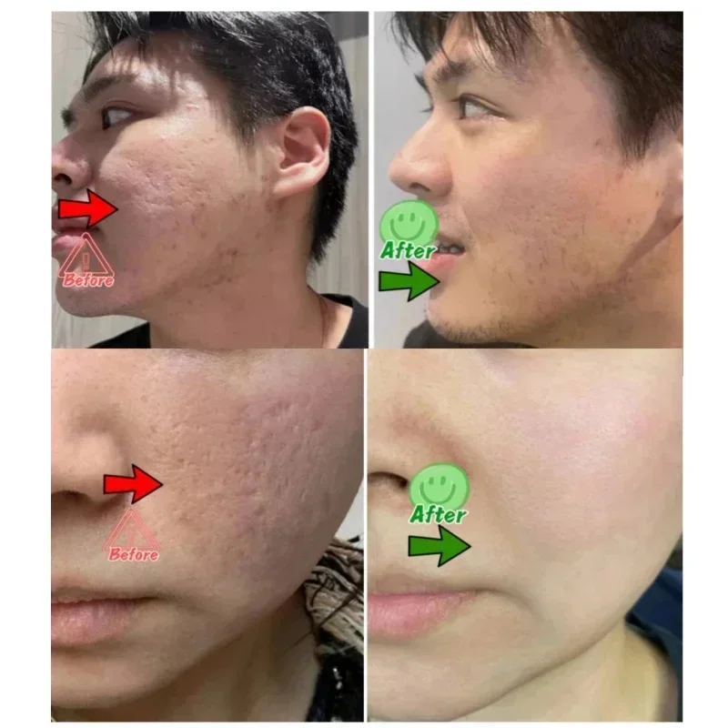 Salicylic Acid Pore Clearing C - đánh giá và giá Salicylic Acid Blackhead Remover