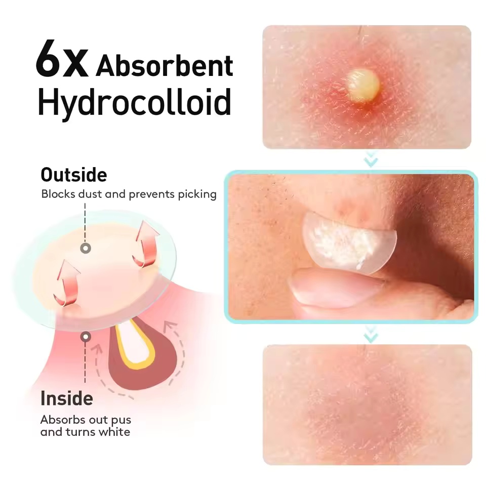 360 pieces/box acne patches -  - đánh giá và giá Massage