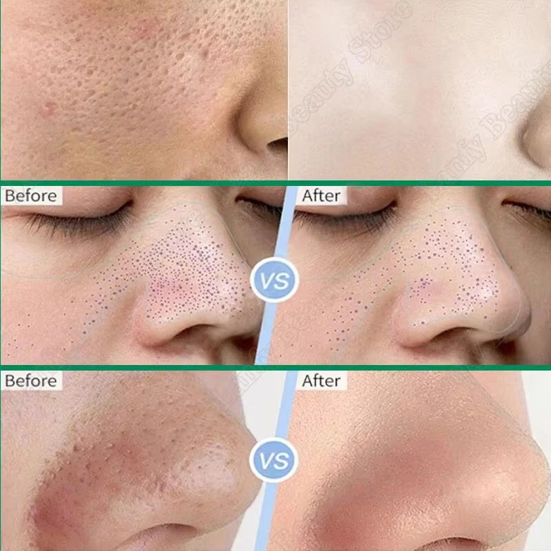 Salicylic Acid Pore Clearing C - đánh giá và giá Salicylic Acid Blackhead Remover